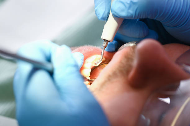 Best Emergency Root Canal Treatment in New Hope, MN